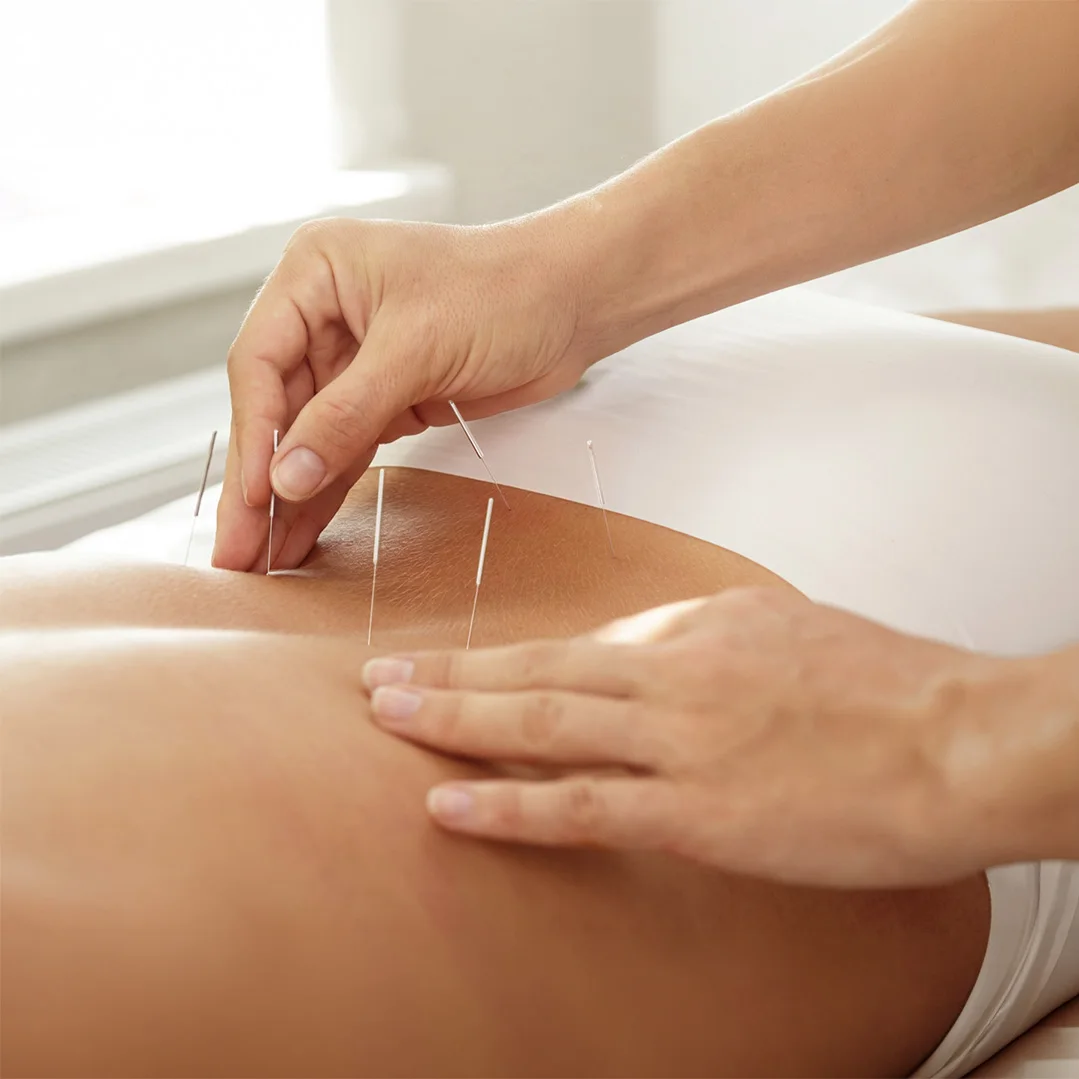 Acupuntura médica (45 a 60 min)